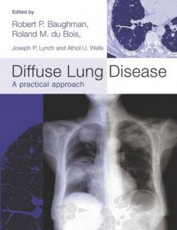 Diffuse Lung Disease: A Practical Approach by Various