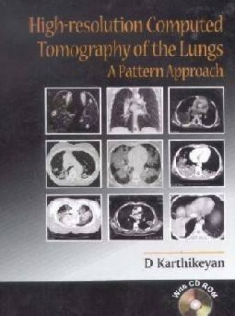 High-Resolution Computed Topography Of The Lungs by D Karthikeyan