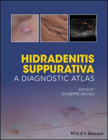 Hidradenitis Suppurativa by Giuseppe Micali