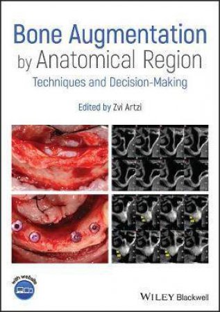 Bone Augmentation By Anatomical Region by Zvi Artzi