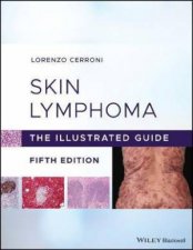 Skin Lymphoma