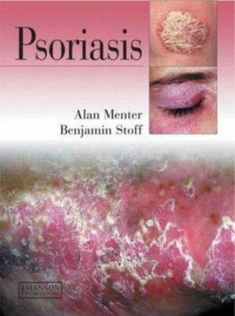 Psoriasis H/C by M. Alan et al Menter